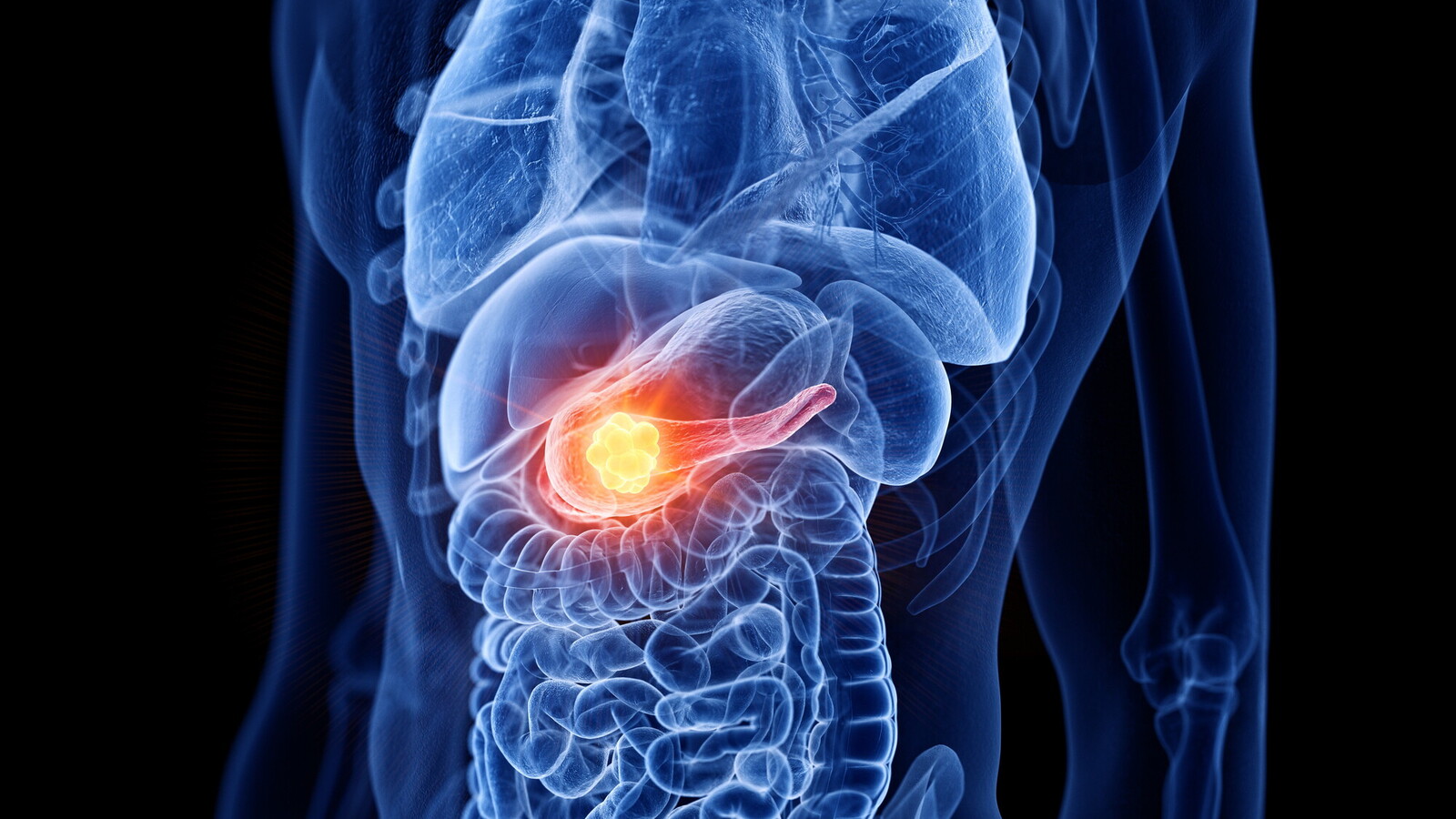 La scienza ha trovato come colpire il tumore "impossibile". La cura del cancro al pancreas a un punto di svolta (di L.Varlese)